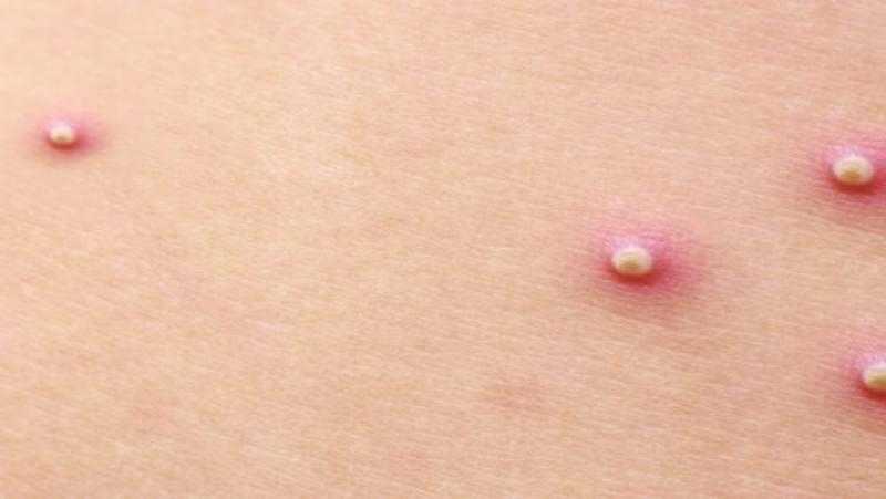 انتبه لصحة بشرتك.. ظهور الحبوب الجلدية قد يشير إلى مشاكل خطيرة في الكلى