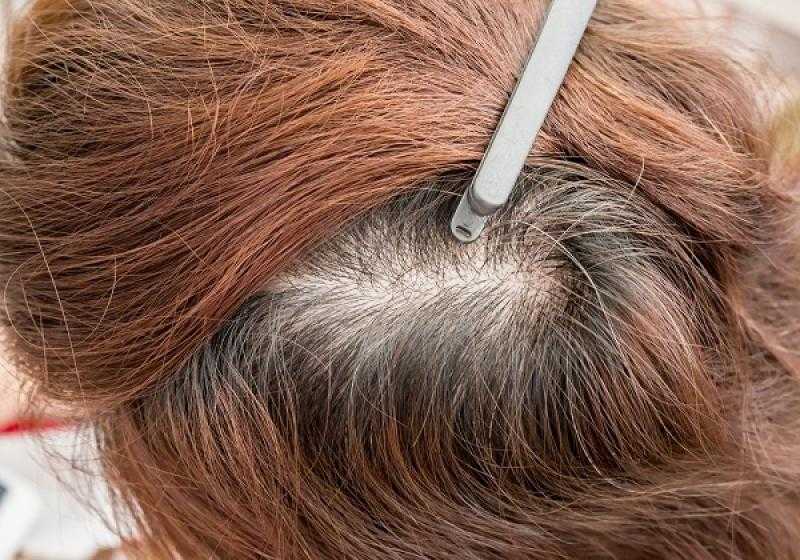 جاذبية الطبيعة.. أبرز العلاجات الطبيعية لنمو الشعر وفعاليتها المثيرة للدهشة